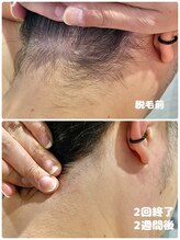 ワイズサロン(Y's salon)/男性うなじ脱毛