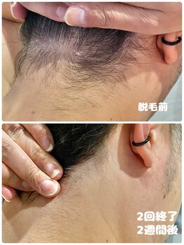 ワイズサロン(Y's salon)/男性うなじ脱毛