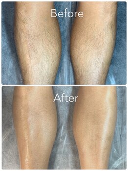 ビオトーン バイ ツリー(biotone by TREE)/男性/Wax脱毛/脚half