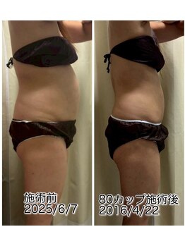 クールスパ(COOL SPA)/50代女性 お腹症例