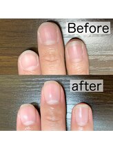 アカツキネイル(Akatsuki Nail)/爪育成　1ヶ月の変化