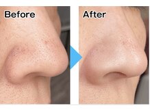 リュミエール(Lumiere)/【症例】毛穴洗浄コース