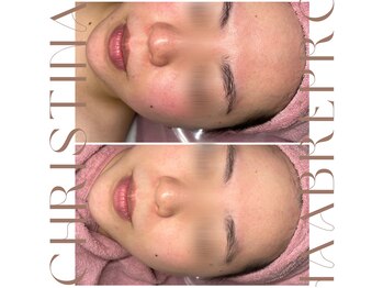 ティセラ(TISERA.)/赤み肌/毛穴開き/乾燥／黒ずみ