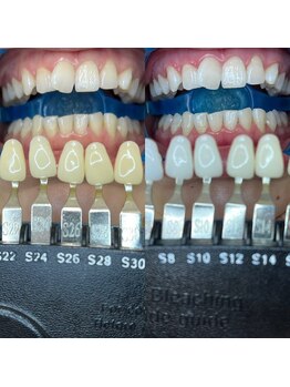 トウキョースワーズ 渋谷店(TOKYO SWRS)/#ホワイトニング #渋谷 #池袋