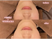 アクトベレッザ(Act BELLEZZA)/小顔矯正×WINBACK4で小顔に！