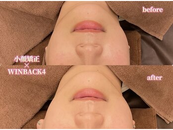 アクトベレッザ(Act BELLEZZA)/小顔矯正×WINBACK4で小顔に！