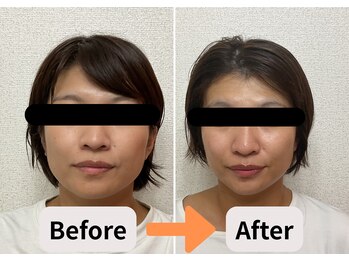 ブプラ 池田店(BUPURA)/小顔 たるみ エラ 歪み 肌質改善