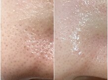 ハリランス(HARILANCE)/毛穴汚れ/黒ずみ/角栓