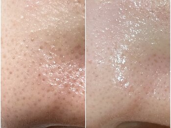 ハリランス(HARILANCE)/毛穴汚れ/黒ずみ/角栓