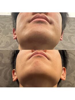 フェリーバ(FELIVA)/Before&After