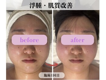 ミピマム 横浜駅前店/むくみ・肌質改善BeforeAfter