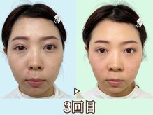 ナチュラルビューティーフェイス 横浜(NBF)/整うペースはそれぞれ/小顔