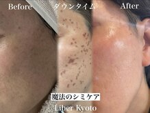 エステティック リベル キョウト 京都駅前店(Esthetic Liber Kyoto)/魔法のシミケア