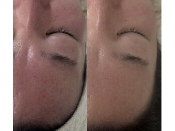 ナチュリー(Naturry)の写真/3日後別人級のお肌になれる。普通のとは質が違います。エステ以上の結果が出ると話題のハーブピーリング!