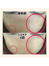 毛穴専科/シミケアし放題！