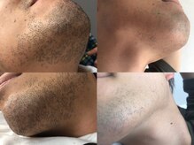 ティアス(t-us)/【脱毛】ひげ脱毛