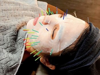 セント 江坂店(SCENT)/・・・幹細胞美容鍼・・・