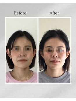 トータルトリートメント優鍼灸院/美容鍼３回の効果