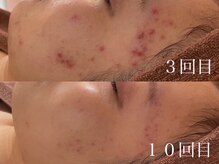 ホワイトアクア 中目黒店(WHITE AQUA)/ハーブピーリング/ニキビ/中目黒