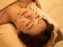 大人気美容鍼灸♪細胞活性化電機施術で、リフトアップを叶える◎
