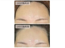 リノン(LINON)/韓国ピーリング 施術回数１回 