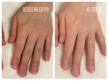 キレイテ 福岡天神店/40代/6回目【博多ハンドケア】