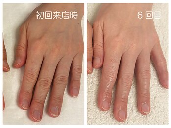 キレイテ 福岡天神店/40代/6回目【博多ハンドケア】