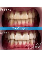 ホワイトニングカフェ 上田店/ホワイトニングビフォーアフター