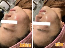 ジョイアビューティー(Gioia beauty)の雰囲気(脂肪分解レモンボトル&レッドショットで二重顎/たるみ等改善◎)