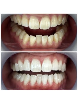 ホワイトニングサロン 京都烏丸店/ホワイトニング施術例