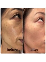 脱毛専門店 ミニマム/剥離なし☆ハーブピーリング