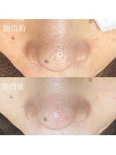 エクラ バイ シャンリィ(eclat by shanLy)/毛穴引き締め！