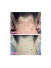 【うなじ脱毛】体験¥2980 男性も！◎