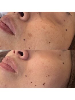 ビジュープラス ひたち野うしく店(Bijou+)/40代【シミケア】