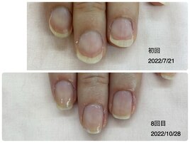 自爪育成