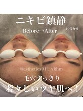 エステティックス ナインワンワン 横浜(Esthetics911) /ニキビケア、鎮静