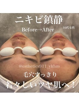 エステティックス ナインワンワン 横浜(Esthetics911) /ニキビケア、鎮静