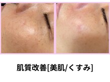 シェリール(Cherir)の雰囲気（肌質改善ベーシック☆今なら何回でも3500円☆）