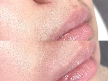 アイブロウドットキス 大宮(iBROW. kiss)/口周りのワックス脱毛