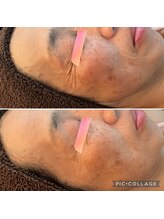 キサラ(Kisara)/美容CL人気のエステ版ダーマ