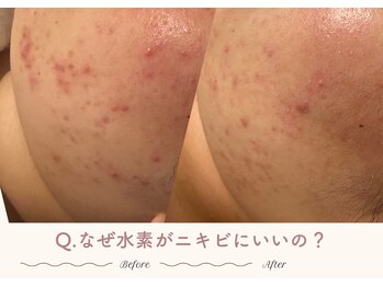 エステティックサロン シーズ/Q.なぜ水素がニキビにいいの？
