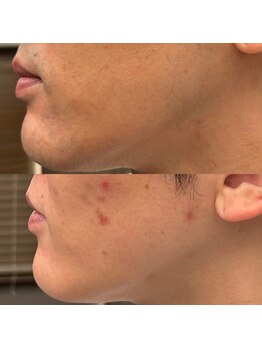 フェリーバ(FELIVA)/Before&After