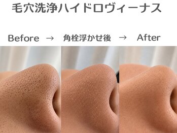 エスポワール(espoir)の写真/【徹底毛穴ケア】毛穴洗浄×ハーブピーリングが8000円!単品ハーブピーリング・ララピール5800円!