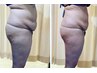 【※60kg以上限定！】究極痩身！応援キャンペーン120分￥￥30,000→￥15,000