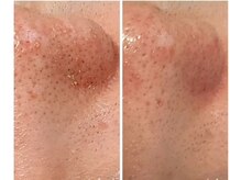 ルヴィオール バイ クニコ(L’VIOR BY Kuniko)/黒ずみ、角栓、毛穴の開きに