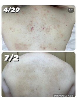 コンフィデンスサロン(Confidence Salon)/【症例】背中ニキビケア