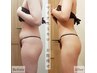 【華奢な二の腕が叶う♪】二の腕ハイパーナイフ＋肩甲骨はがし《60分》