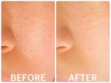 ハーブピーリング 恵比寿/毛穴引締めハーブピーリング