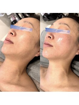 リンパリラクゼーション ネトピー(Netopy)/小顔コルギ