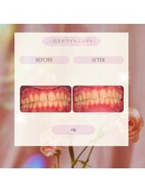 プラスビー 2号店(+b)/ホワイトニングビフォーアフター